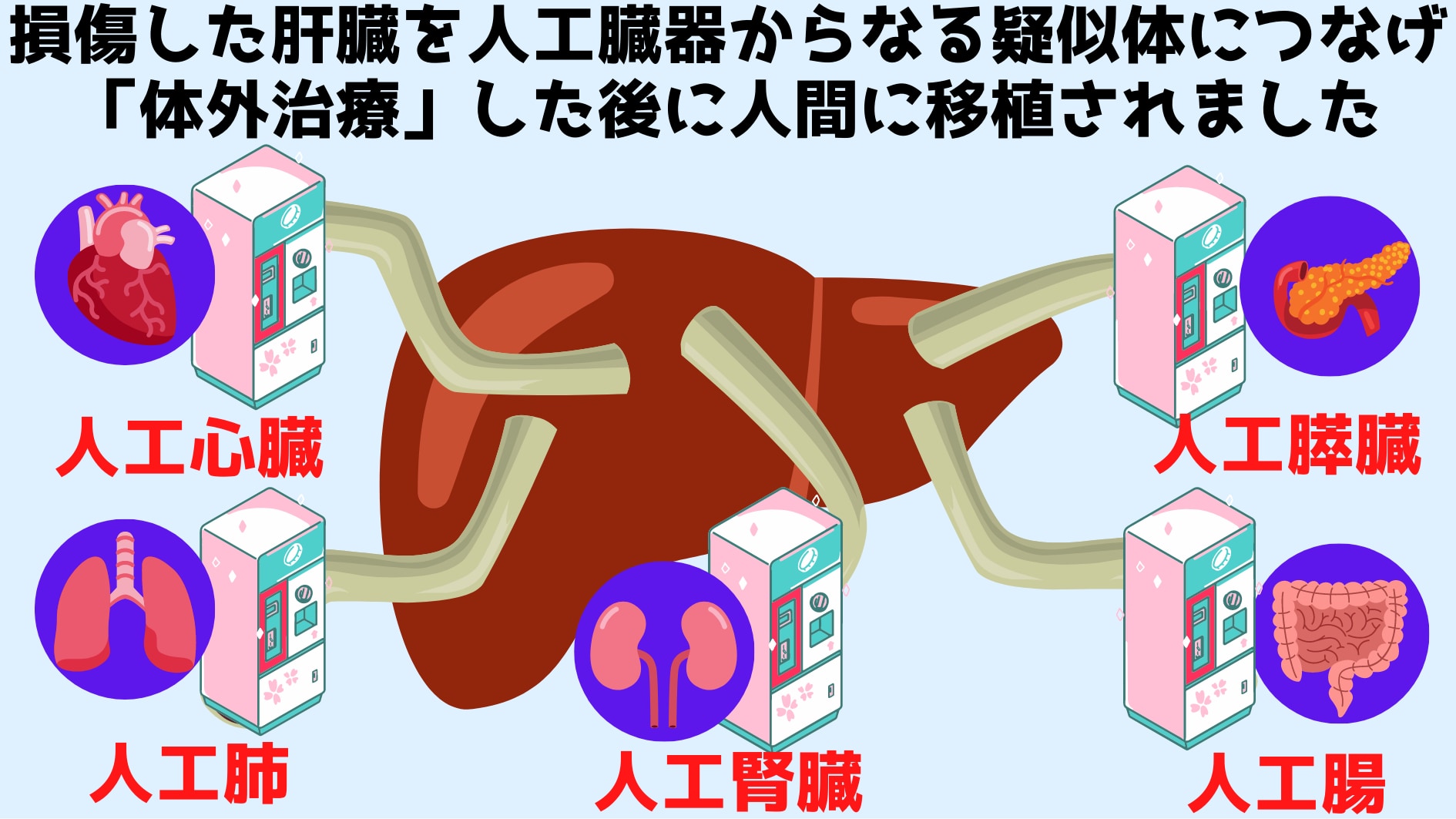 摘出した肝臓を機械に繋いで3日間「体外治療」し移植することに成功！