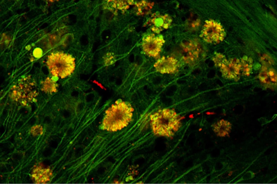 脳細胞に咲く「毒の花」がアルツハイマー病の真の原因だった！ (2/3) - 科学ニュースメディア！ナゾロジー