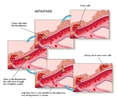 がんの転移プロセス。血液を通して広がる