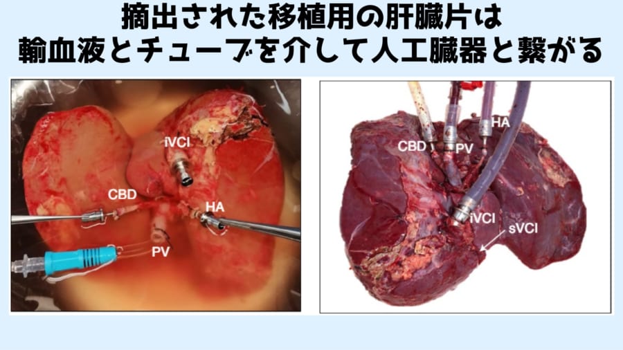 肝臓を人工臓器につなげるために複数のチューブがとりつけられた