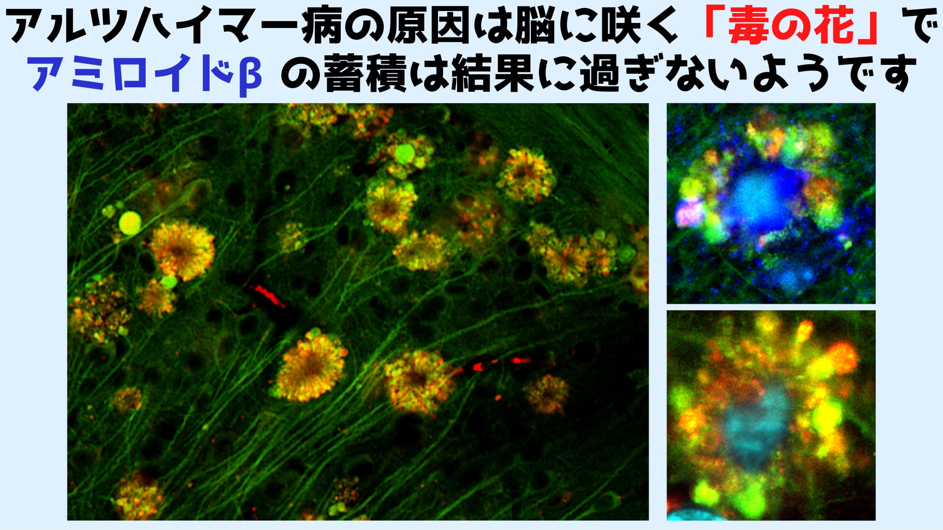 脳細胞に咲く「毒の花」がアルツハイマー病の真の原因と判明！の画像 4/5