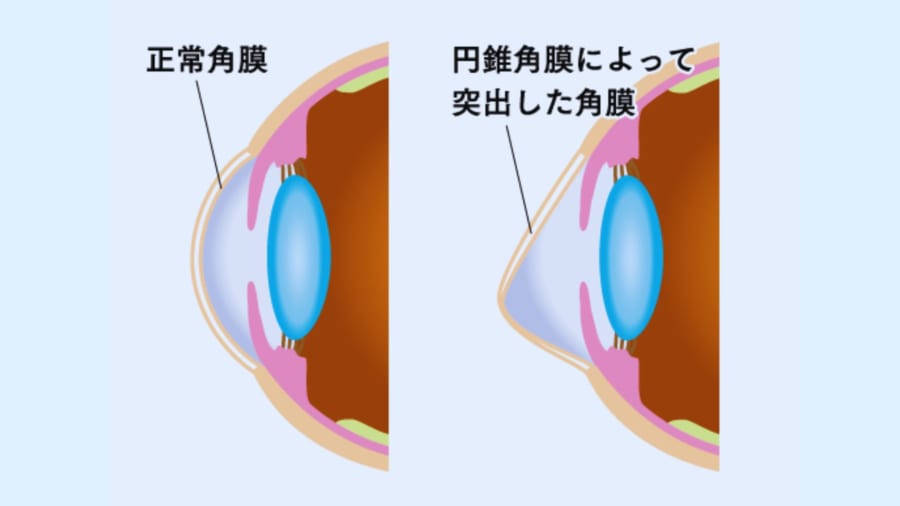 円錐角膜の症状が進行すると、光を正しく目に届けることがでなくなり、網膜に光を感じる力が残っていても物の輪郭が全く認識できなくなってしまいます。