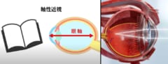 眼軸長が伸びる（左）と、網膜の手前でピントが合う（右）ようになり、遠くが見えない