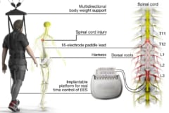 脊髄に電気刺激を与える「硬膜外電気刺激（EES）」