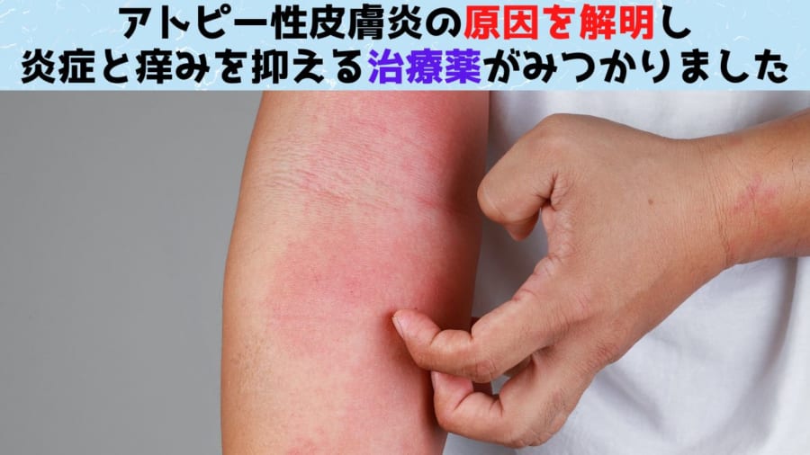 アトピー性皮膚炎の痒みの原因解明とその治療薬を発見 - ナゾロジー