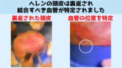 運び込まれた頭皮は洗浄され裏返しの状態で血栓防止措置がとられました