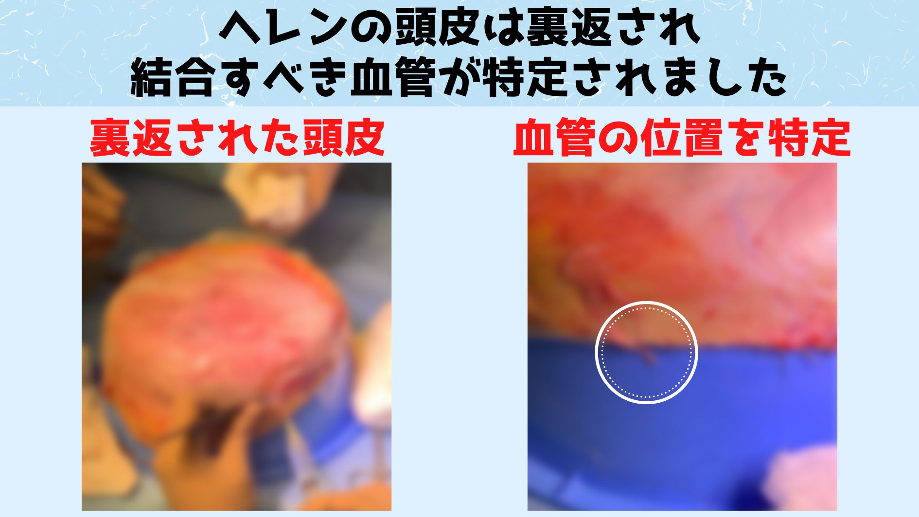 運び込まれた頭皮は洗浄され裏返しの状態で血栓防止措置がとられました