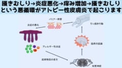 アトピー性皮膚炎の悪循環