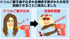 ドリル事故で全て剥がれてしまった「頭皮」を元に戻すことに成功！