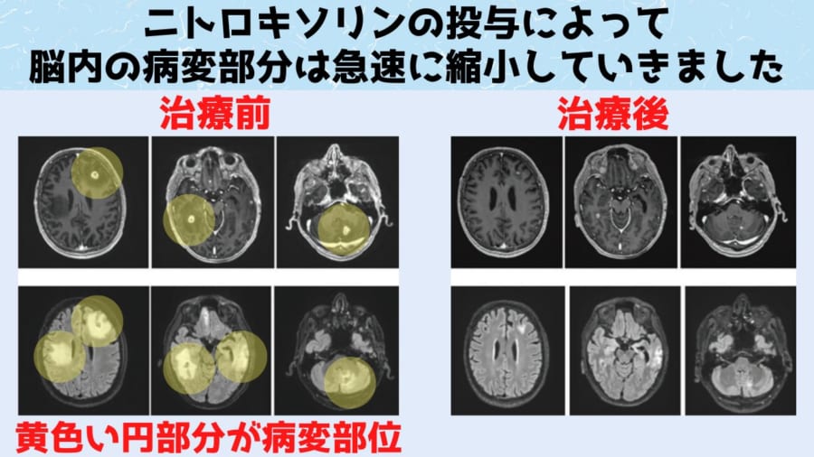 脳内にある病変部分がニトロキソリンの投与によって大幅に減少している。医師たちは将来的に男性がニトロキソリンを飲まなくてもよくなる可能性があると述べています