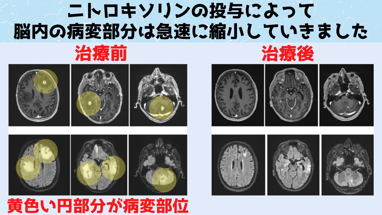 脳内にある病変部分がニトロキソリンの投与によって大幅に減少している。医師たちは将来的に男性がニトロキソリンを飲まなくてもよくなる可能性があると述べています