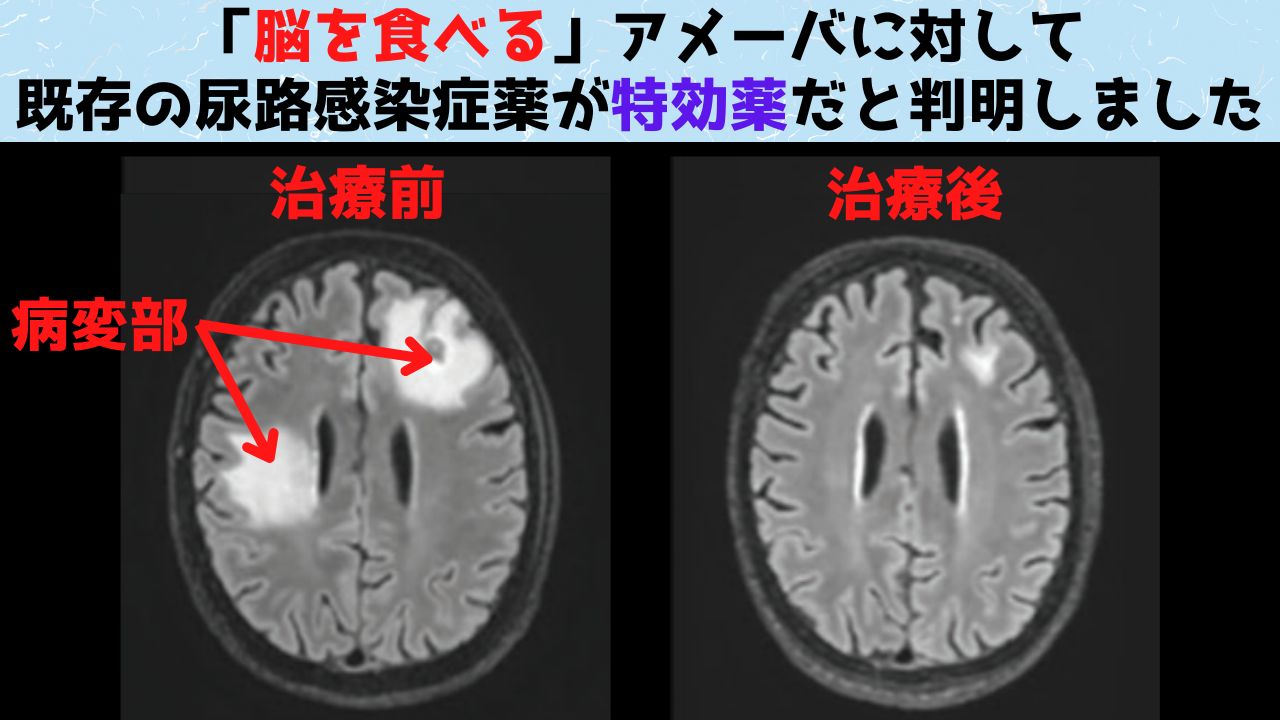 「脳を食べる」アメーバに対する特効薬を発見！1週間で改善