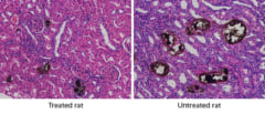 左：ナノ粒子を投与したラット、右：投与していないラット。明らかに結石の大きさが違う