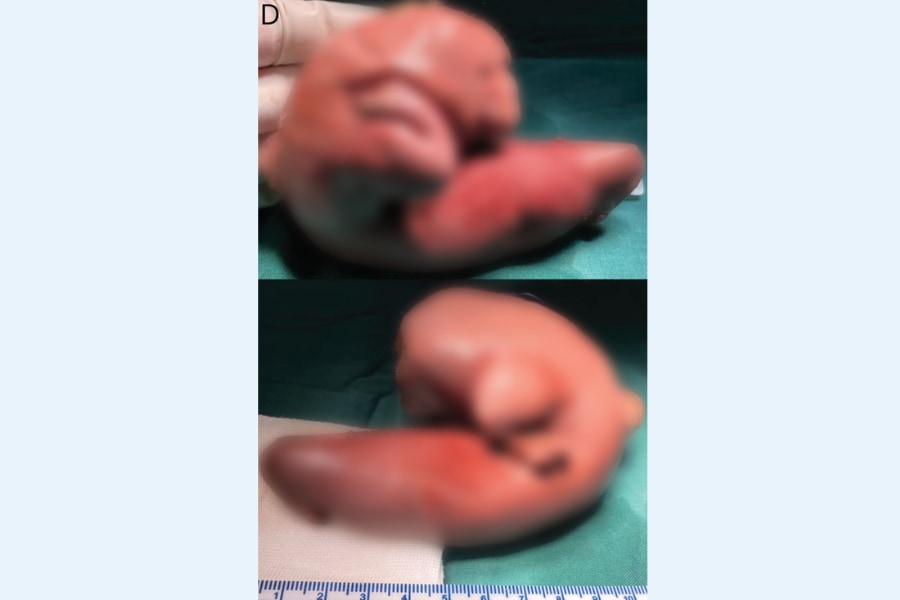 1歳女児の頭蓋内から「未発達の胎児」が摘出された異例のケースの画像