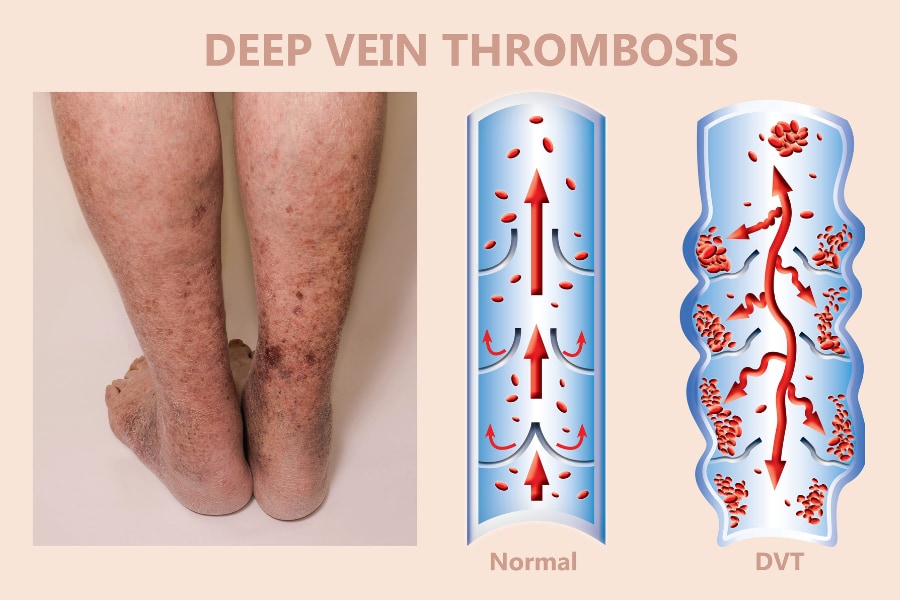 静脈血栓塞栓症の1つである「深部静脈血栓症」と通常時の比較