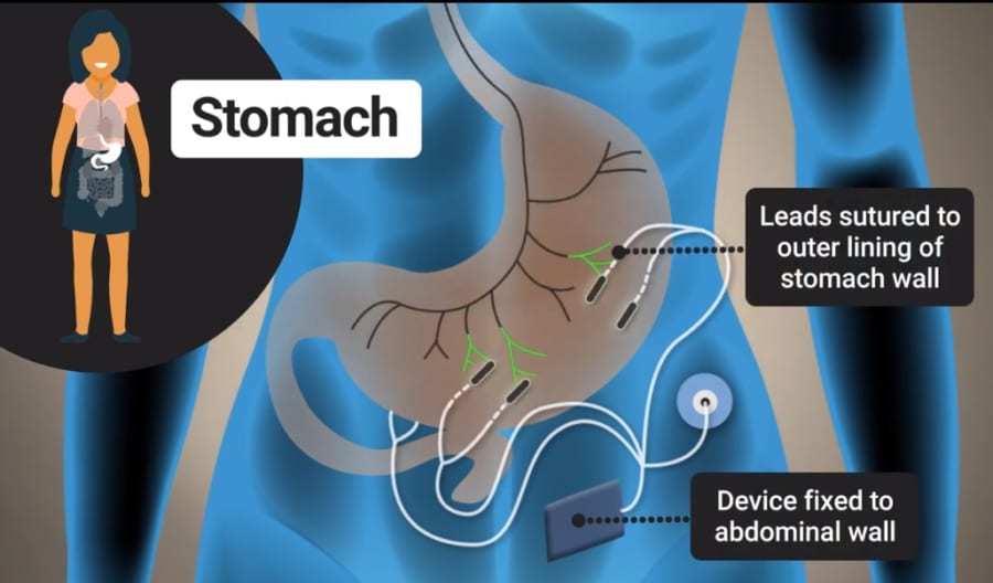 電気刺激でホルモンを刺激し、食欲不振を解消する方法