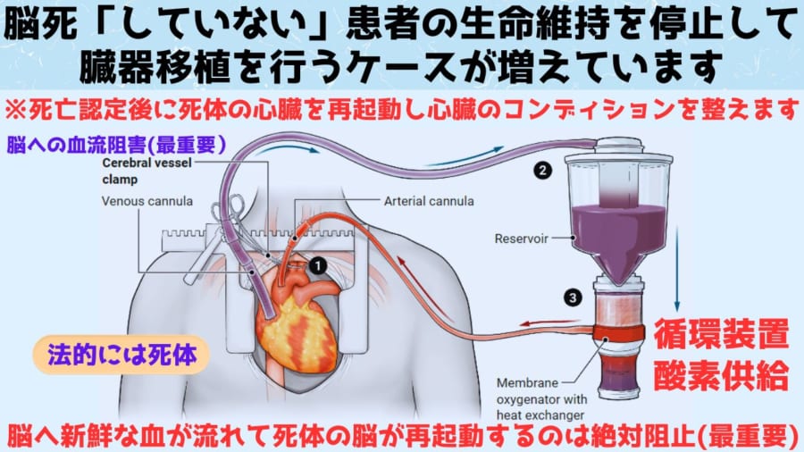 揺らぐ死の定義ー増えつつある脳死「していない」患者からの臓器
