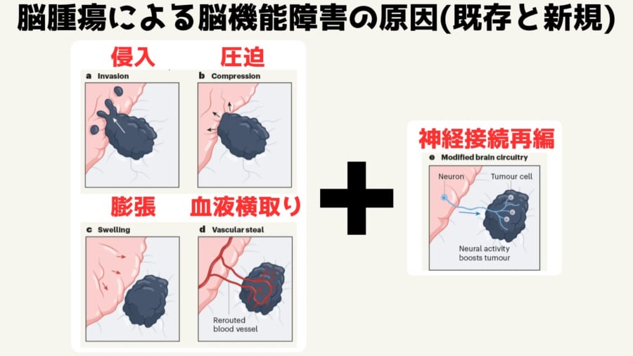 思考自体が脳腫瘍の増殖を促進していると判明！