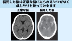 脳死した脳では脳はもとの構造を保てなくなります