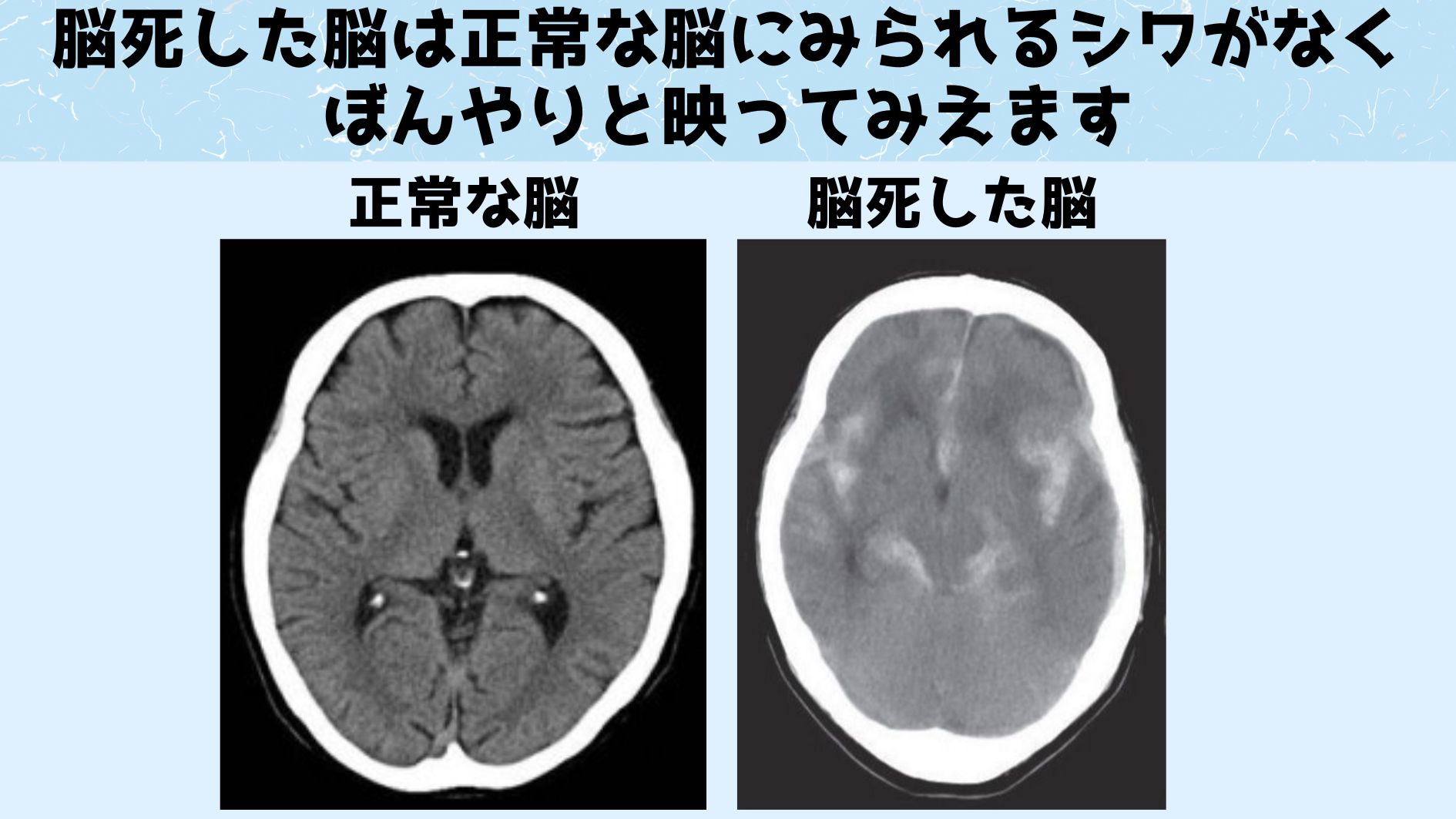 脳死した脳では脳はもとの構造を保てなくなります