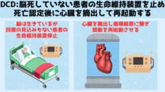 DCDでは脳死していないものの助かる見込みのない患者を死亡させて移植用臓器を摘出します