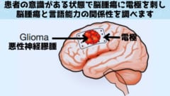 思考自体が脳腫瘍の増殖を促進していると判明！