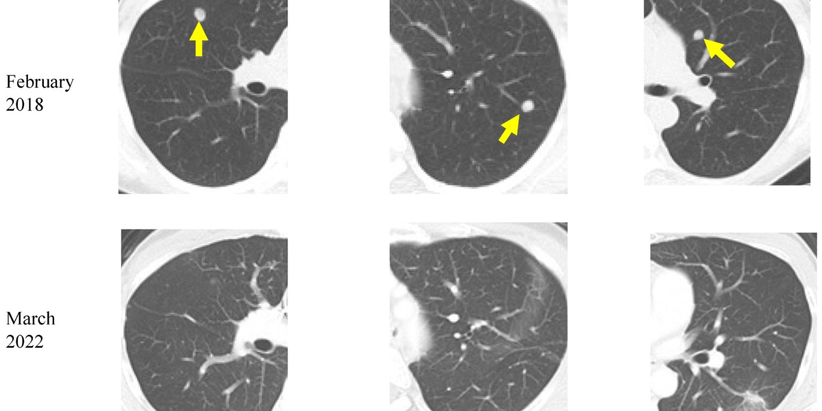 食事でがん患者の生存期間を劇的に改善！ケトン食療法の研究の画像 1/4