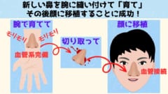 新しい鼻を腕に縫い付けて「育てる」ことに成功！