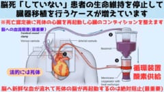 脳死「していない」患者からの臓器移植が主流になりつつある