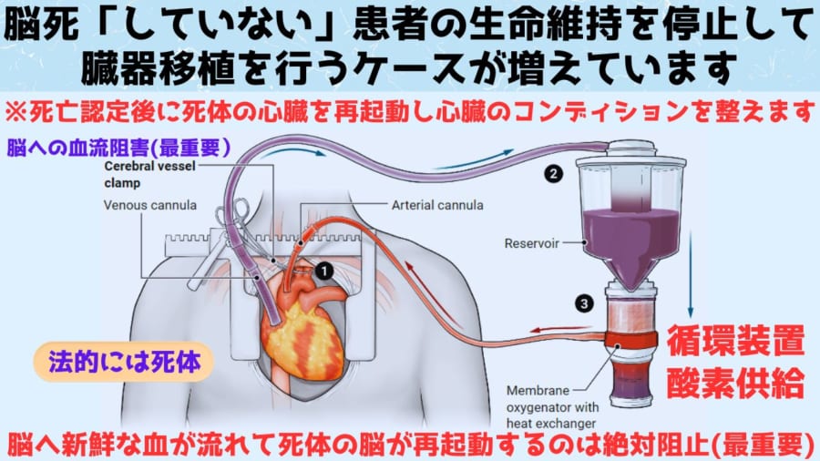 脳死「していない」患者からの臓器移植が主流になりつつある