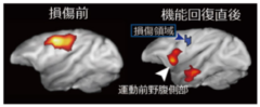 損傷後は脳の活動箇所が変わる