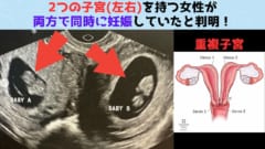 2つの子宮を持つ女性が両方で妊娠していたと判明！