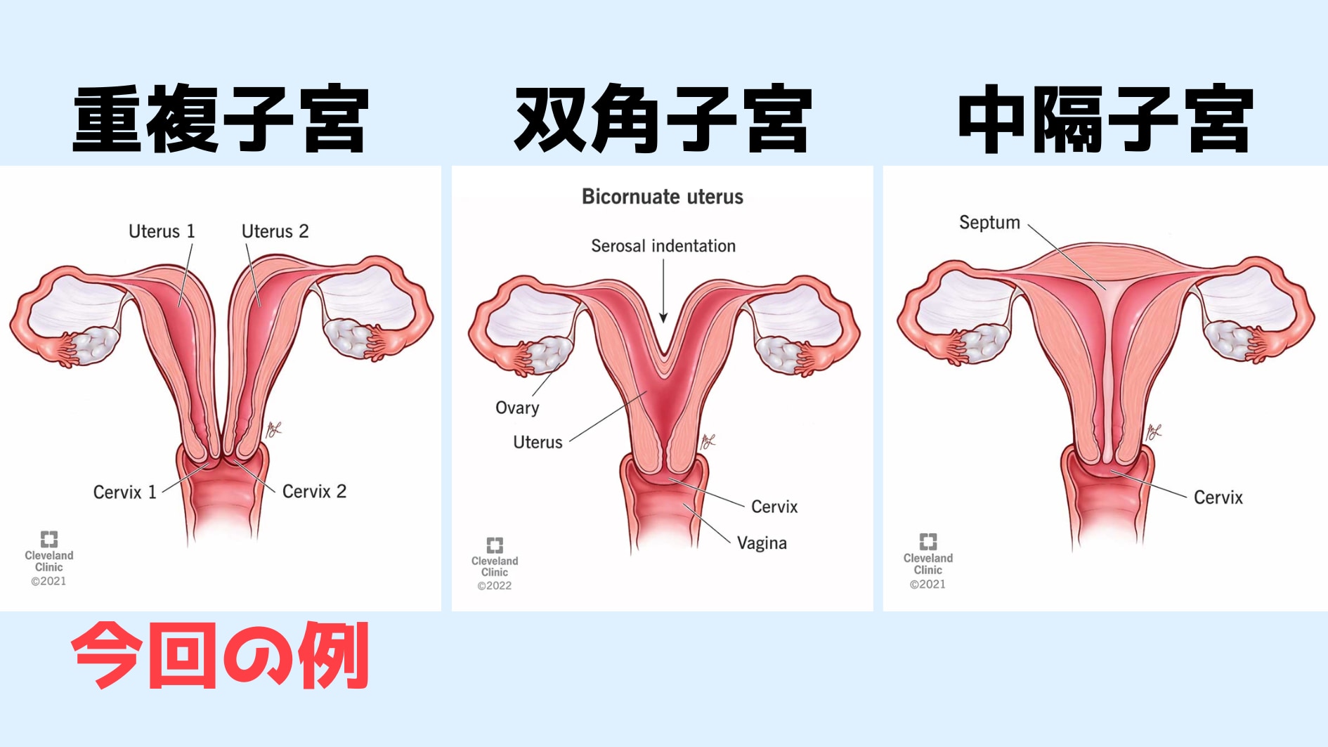 2つの子宮を持つ女性が両方で妊娠していたと判明！