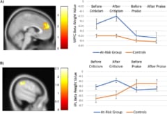 うつ病のリスクがある人は、批判を聞いた後、2 つの DMN 領域 (A) 内側前頭前皮質 と (B) 下頭頂小葉 で著しく高い活性化を示しました