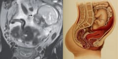 子宮に胎児がいない⁈ 「腹腔で赤ちゃんを妊娠」した極めて稀なケースが報告される