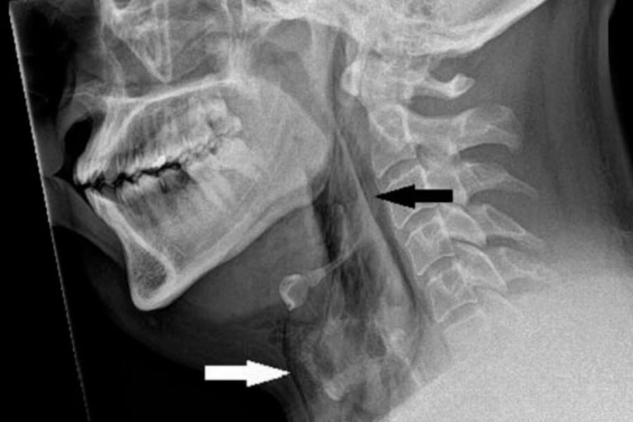 「くしゃみの我慢」で喉が裂ける!?世界初の症例を確認