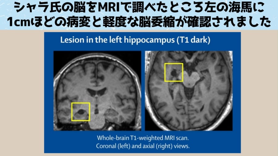 相貌変形視は何らかの脳への（特に顔認識や視覚領域への）損傷がキッカケになっている