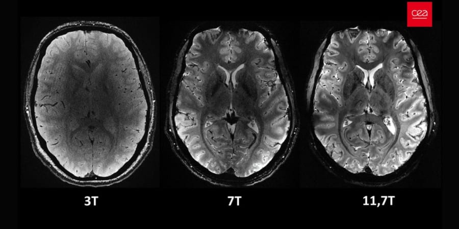脳が鮮明に見える！世界最強の磁束密度で脳をスキャンするMRI