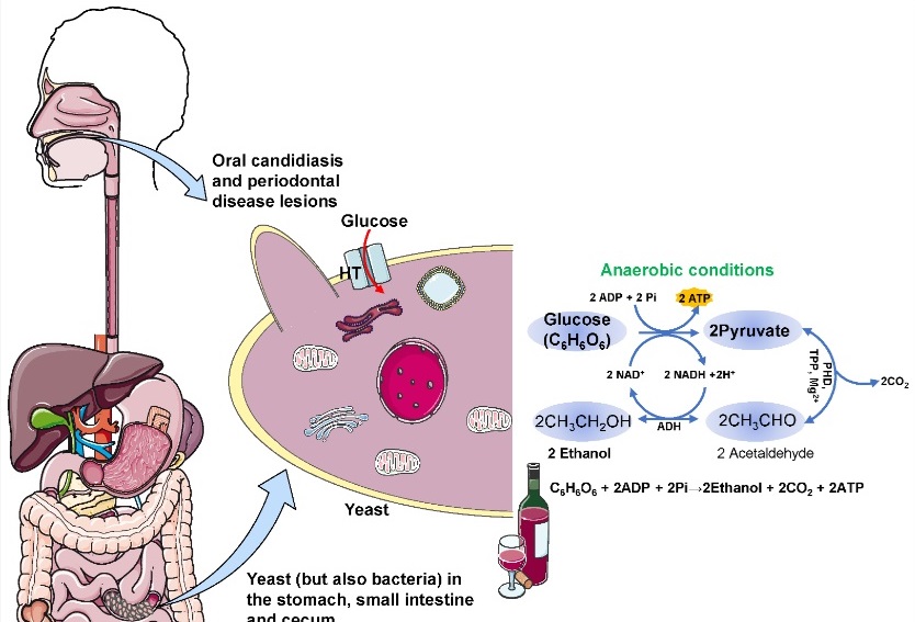 腸内で酵母と細菌によるグルコースからエタノールへの代謝が起き、患者は酩酊状態になる