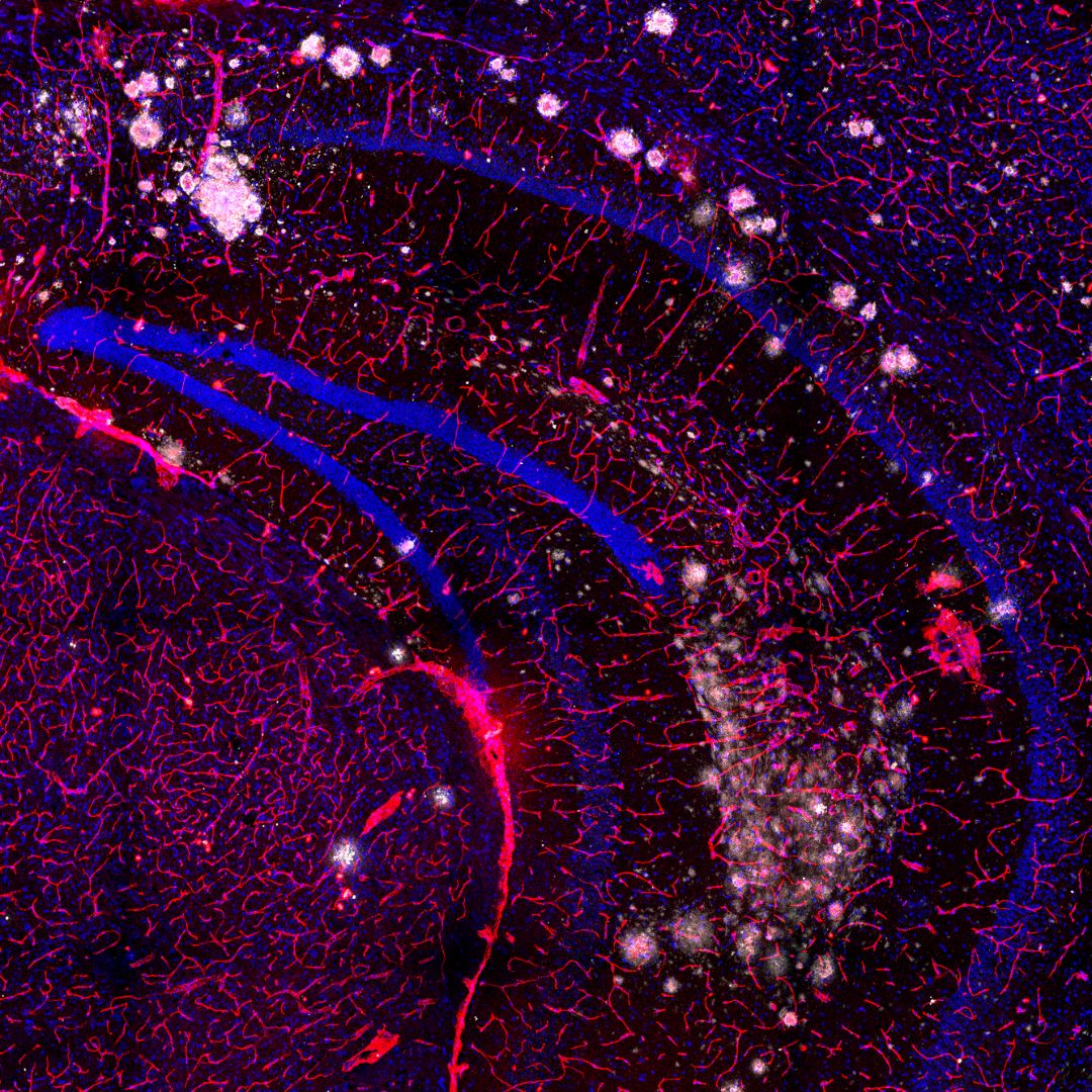 Cloudy Brain with a Chance of Forgetfulness