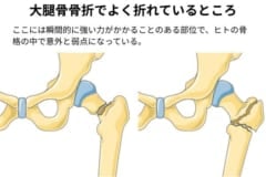 強い力のかかる大腿骨頸部が骨粗しょう症で脆くなっていると折れやすい