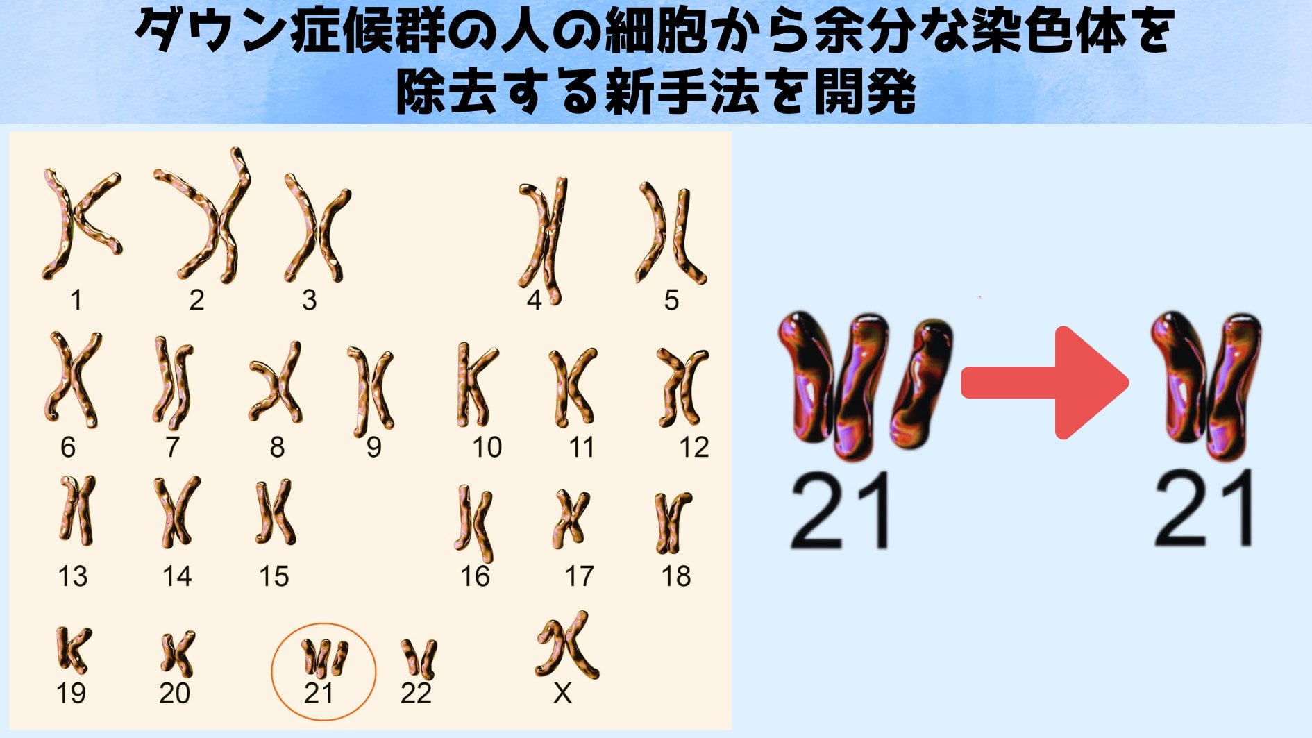 ダウン症候群の人の細胞から余分な染色体を除去する新手法を開発