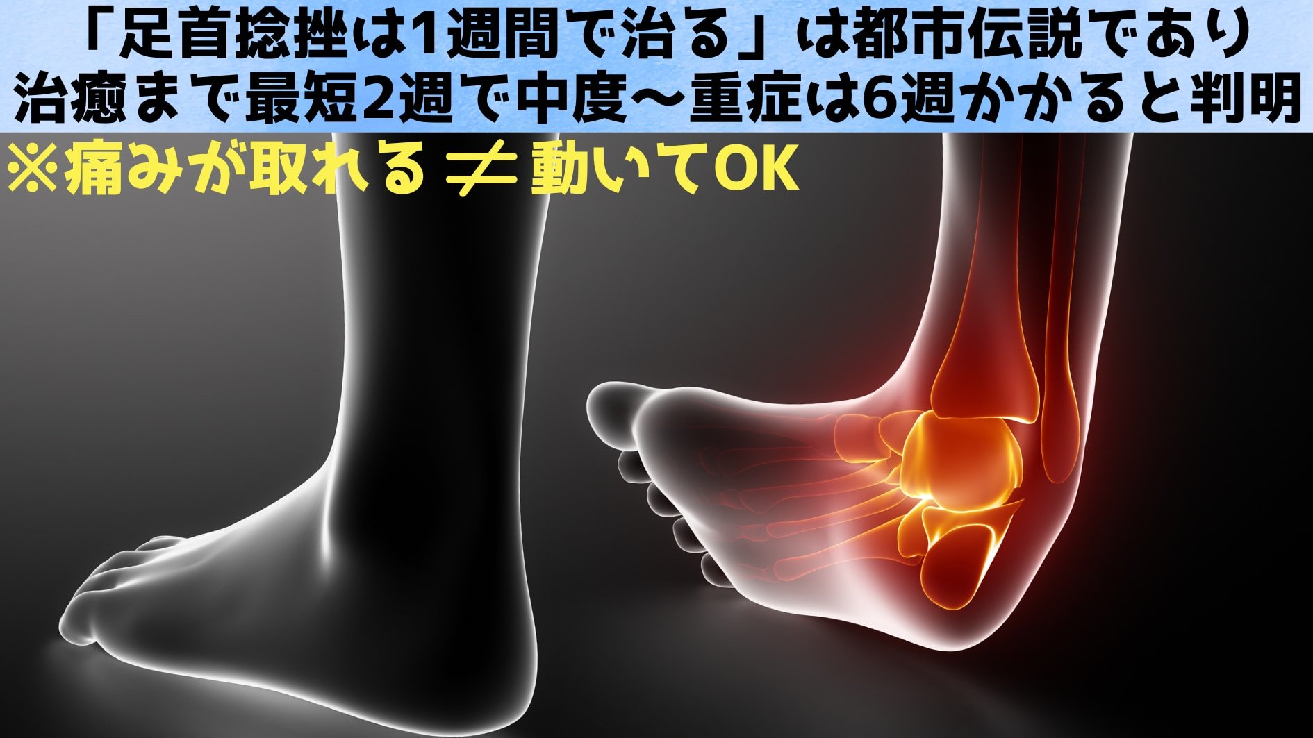 「足首捻挫は1週間で治る」は都市伝説！最短2週・重症6週の真実
