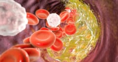 新旧2種の薬剤の組み合わせでLDLコレステロール値が49％低下するの画像 1/4