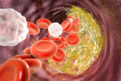 新旧2種の薬剤の組み合わせでLDLコレステロール値が49％低下するの画像 4/4
