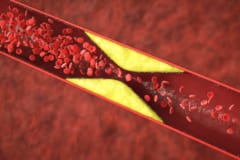 新旧2種の薬剤の組み合わせでLDLコレステロール値が49％低下するの画像 2/4