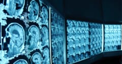 最近生まれた人々は、以前の世代に比べて、認知症になる可能性が低いの画像 1/3