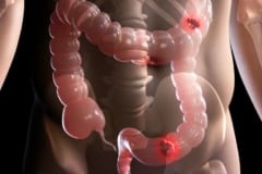 大腸がん治療後の運動習慣は「再発リスク28％」「死亡リスク37％」低減するの画像 2/3