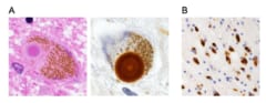 パーキンソン病は脳ではなく、実は腎臓が原因の病気かもしれないの画像 2/3