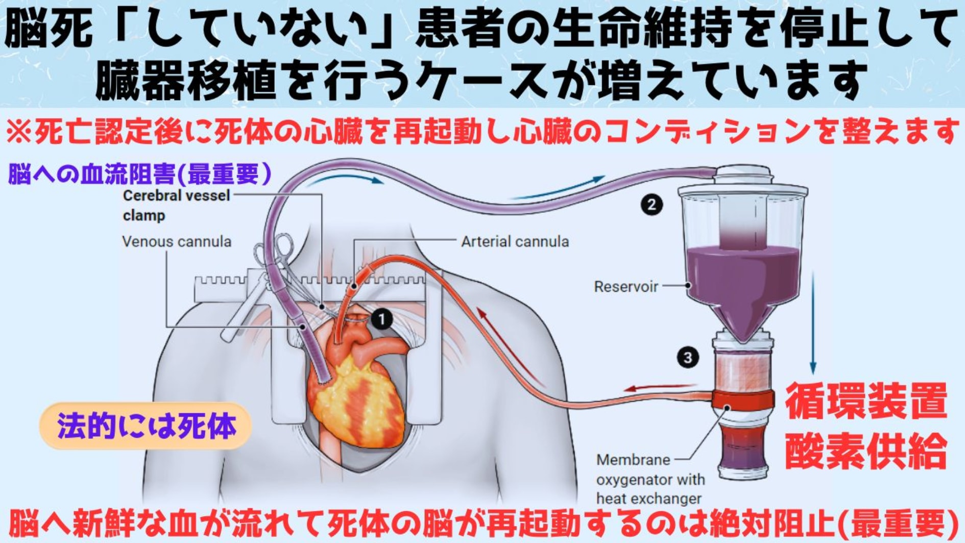 体内常温灌流法(NRP)